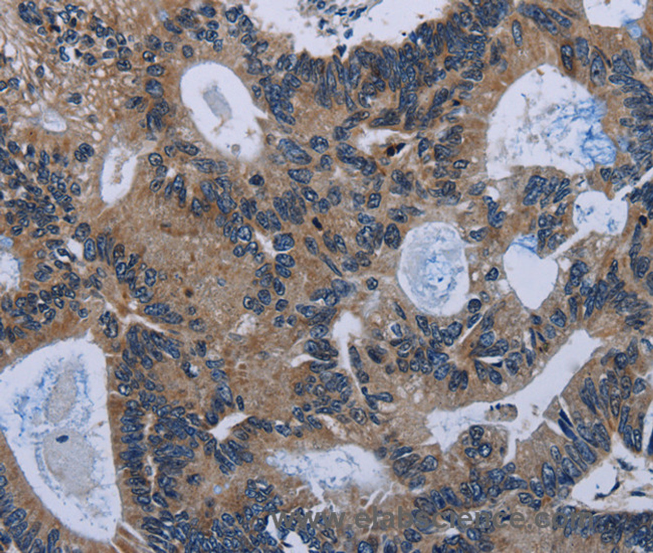 Immunohistochemistry of paraffin-embedded Human colon cancer tissue using IRGM Polyclonal Antibody at dilution 1:50