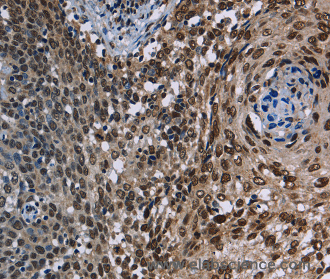 Immunohistochemistry of paraffin-embedded Human cervical cancer using KDM3B Polyclonal Antibody at dilution of 1:40