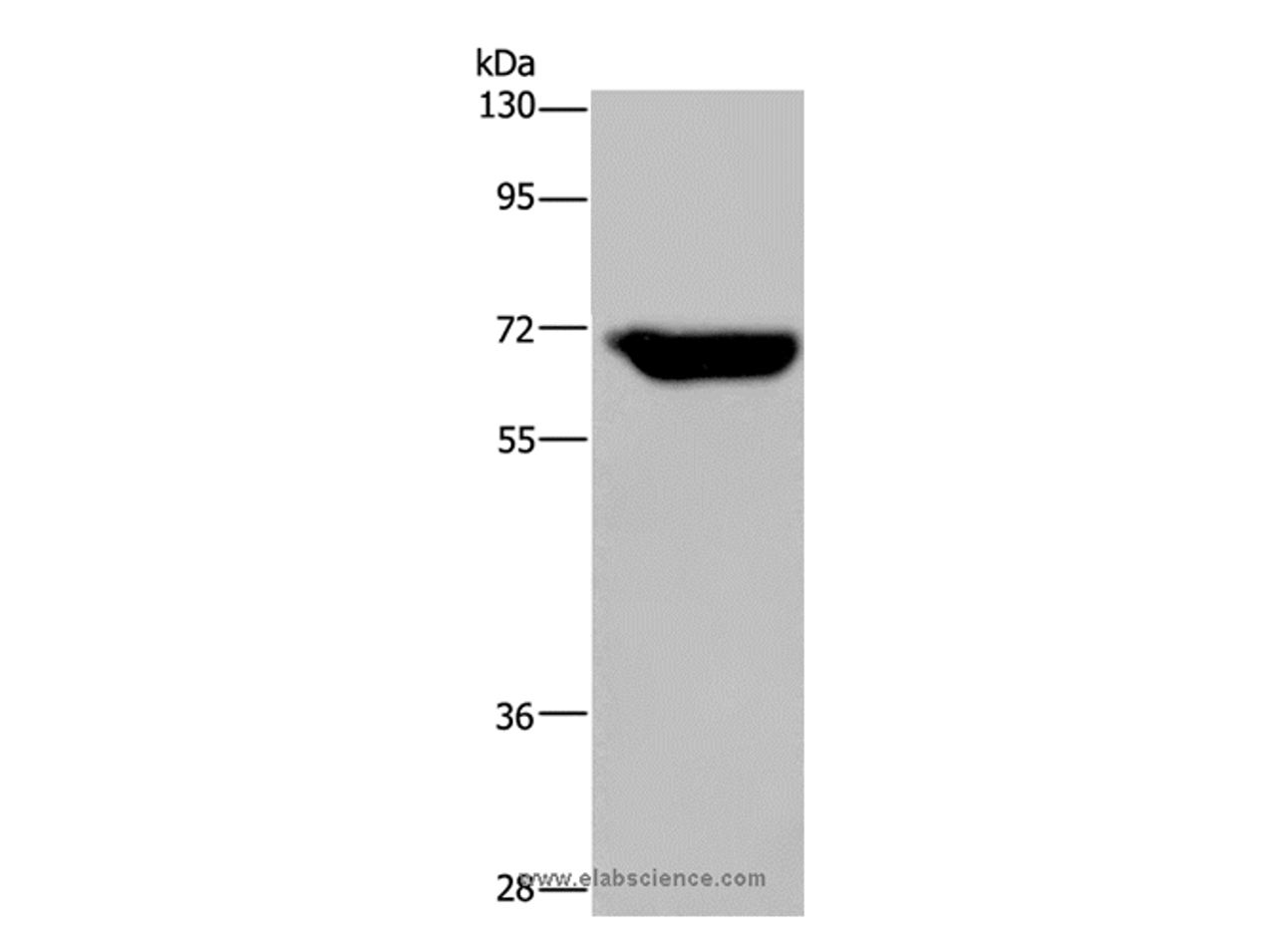 Western Blot analysis of Human breast infiltRative duct tissue using JMJD6 Polyclonal Antibody at dilution of 1:425
