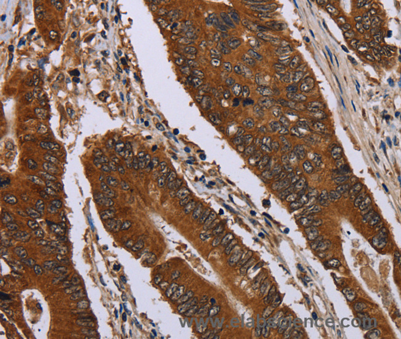 Immunohistochemistry of paraffin-embedded Human colon cancer using Catenin gamma Polyclonal Antibody at dilution of 1:40