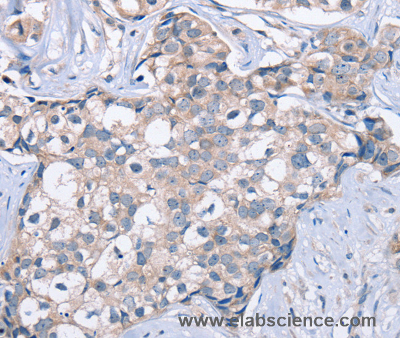 Immunohistochemistry of paraffin-embedded Human breast cancer tissue using KCNQ5 Polyclonal Antibody at dilution 1:60