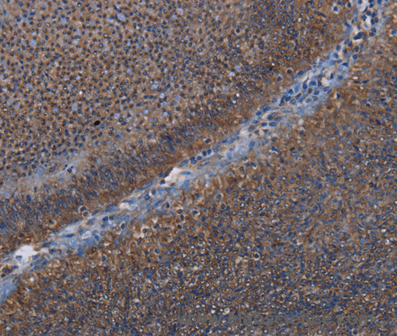 Immunohistochemistry of paraffin-embedded Human rectal cancer using P3H3 Polyclonal Antibody at dilution of 1:50