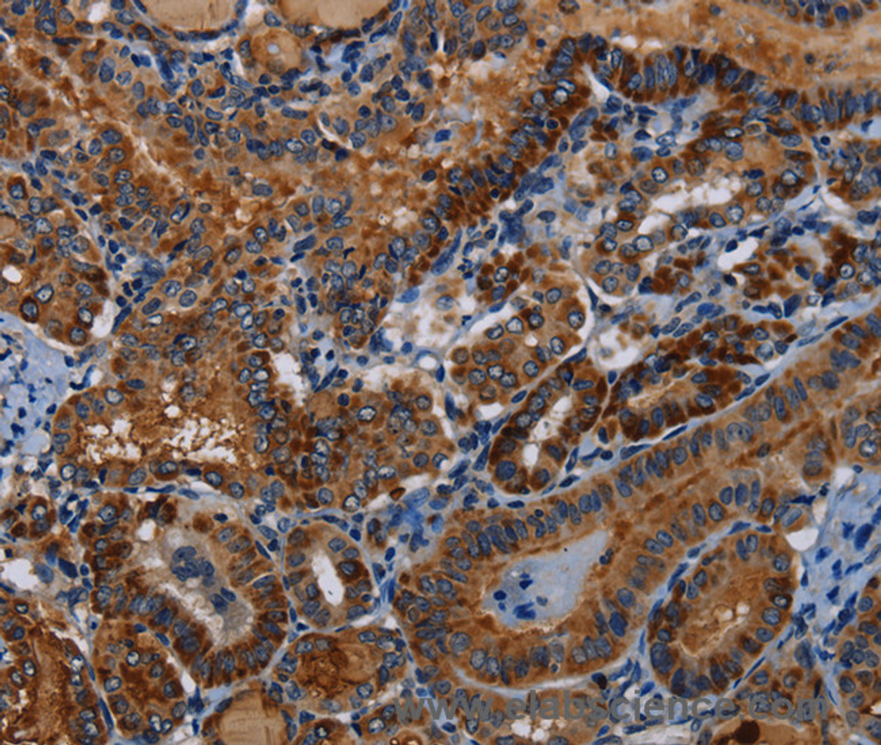 Immunohistochemistry of paraffin-embedded Human thyroid cancer tissue using PIDD1 Polyclonal Antibody at dilution 1:30