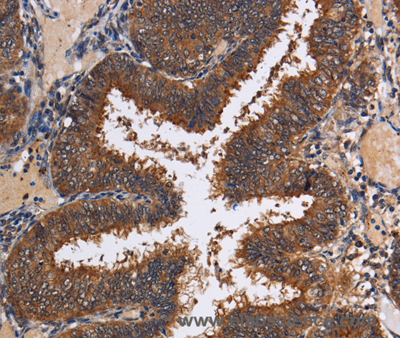 Immunohistochemistry of paraffin-embedded Human colon cancer tissue using LRRC57 Polyclonal Antibody at dilution 1:40