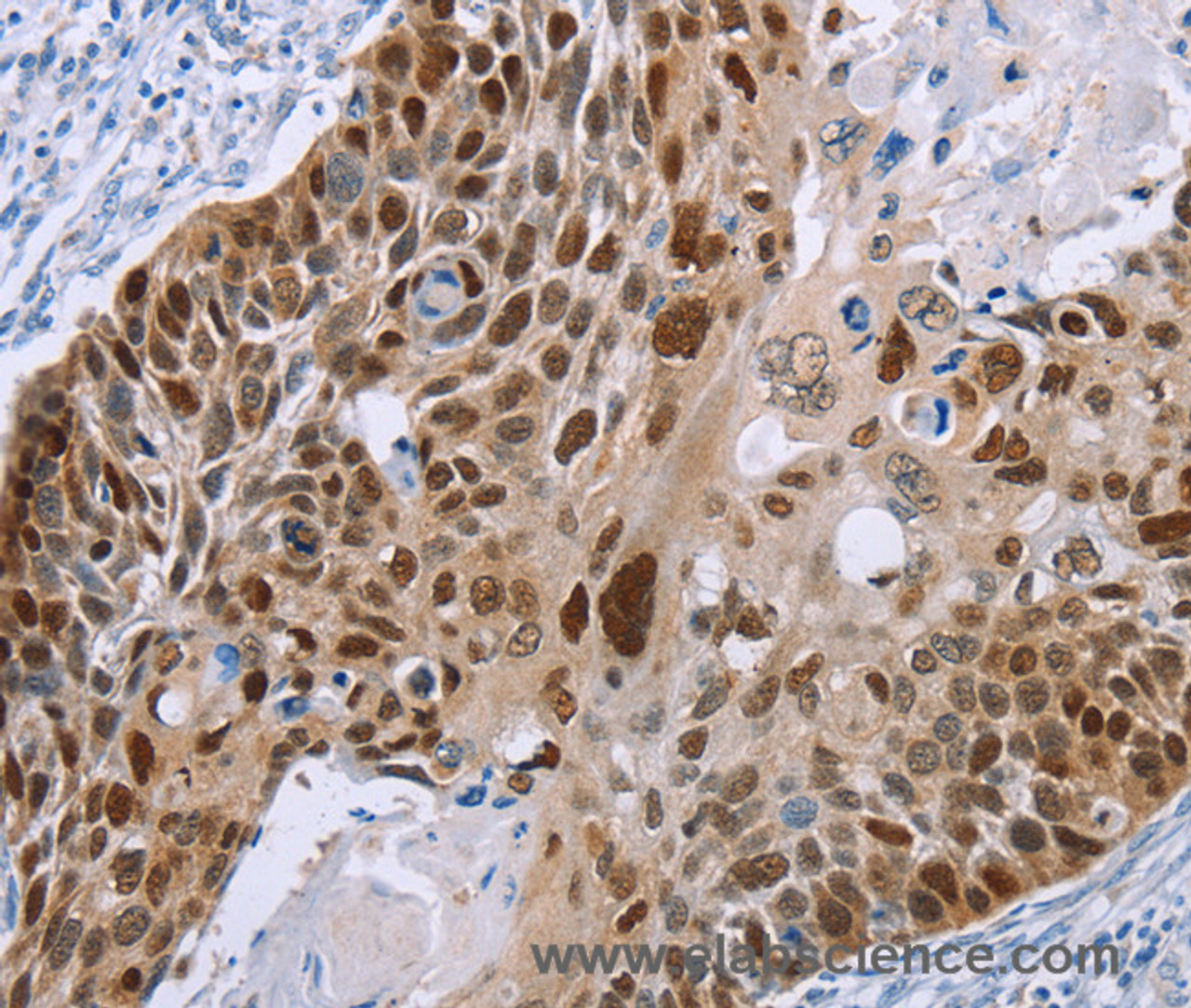 Immunohistochemistry of paraffin-embedded Human esophagus cancer using MAGEA10 Polyclonal Antibody at dilution of 1:50