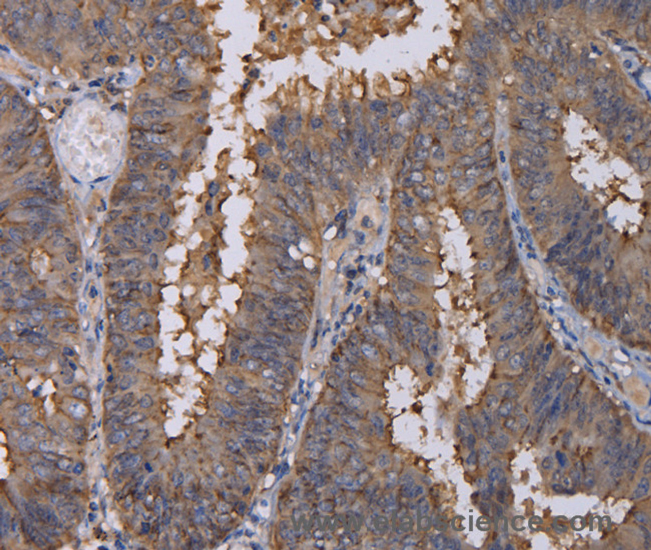 Immunohistochemistry of paraffin-embedded Human colon cancer using REG3G Polyclonal Antibody at dilution of 1:40