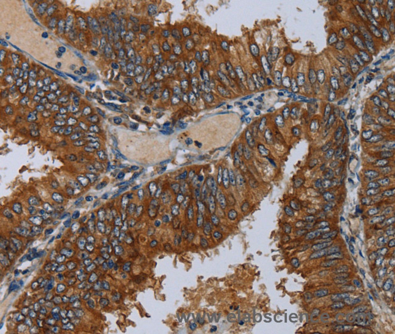 Immunohistochemistry of paraffin-embedded Human colon cancer using MIER2 Polyclonal Antibody at dilution of 1:50