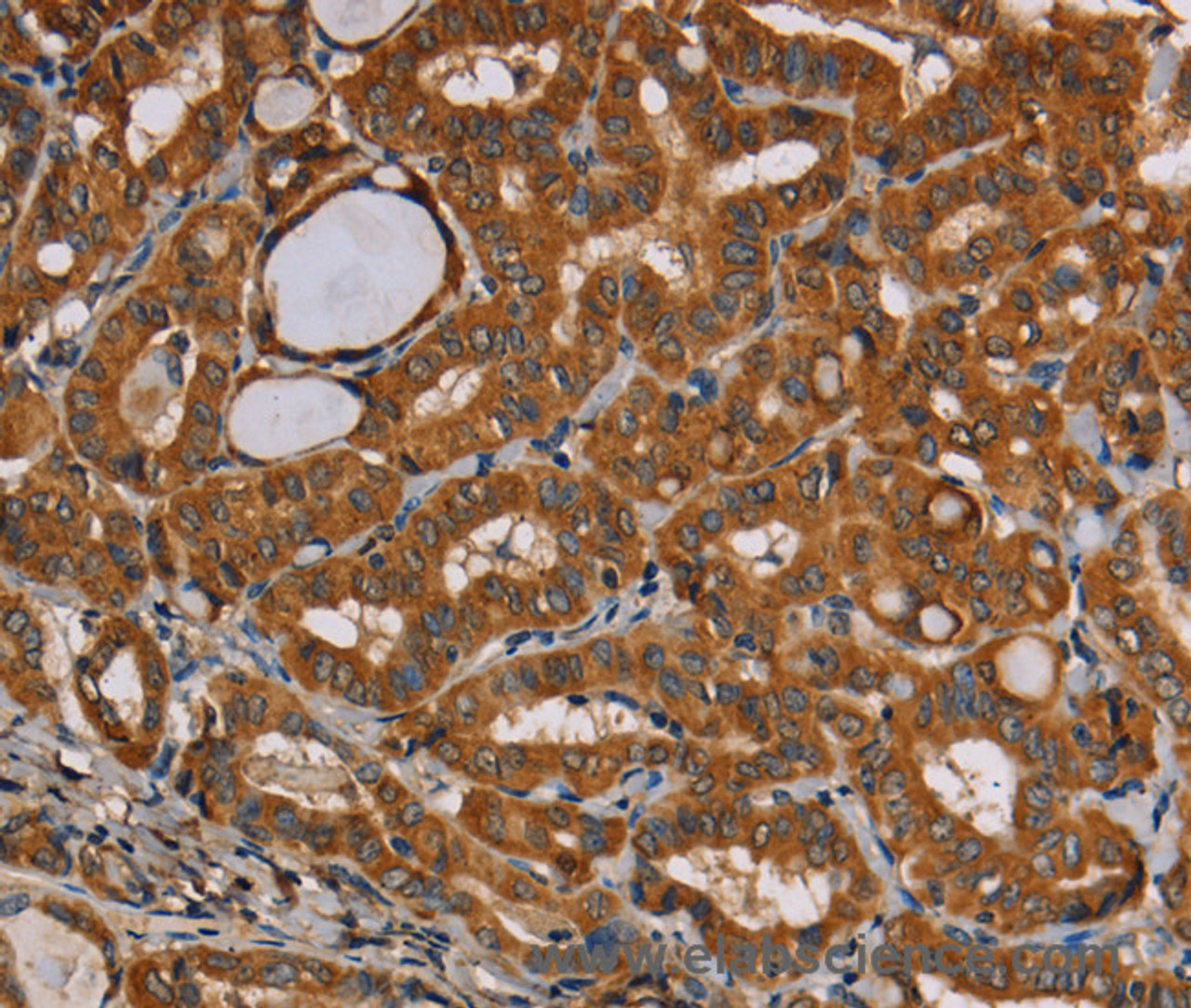 Immunohistochemistry of paraffin-embedded Human thyroid cancer tissue using CENPU Polyclonal Antibody at dilution 1:30