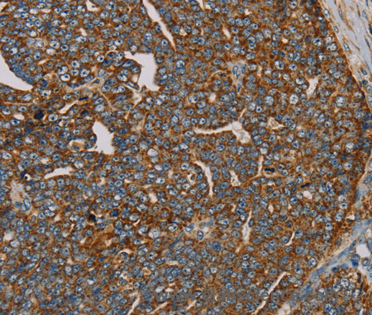 Immunohistochemistry of paraffin-embedded Human cervical cancer using MRPL28 Polyclonal Antibody at dilution of 1:45