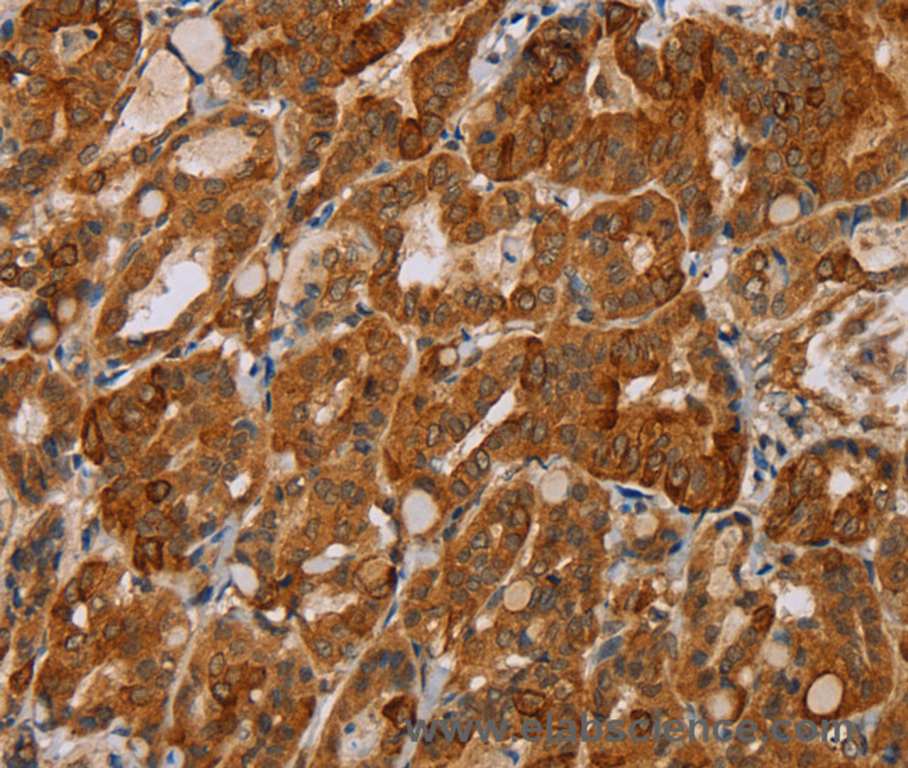 Immunohistochemistry of paraffin-embedded Human thyroid cancer tissue using MTUS1 Polyclonal Antibody at dilution 1:40