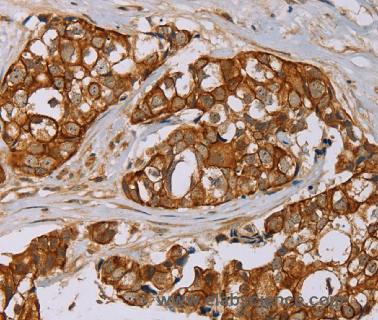 Immunohistochemistry of paraffin-embedded Human breast cancer tissue using MTUS1 Polyclonal Antibody at dilution 1:40