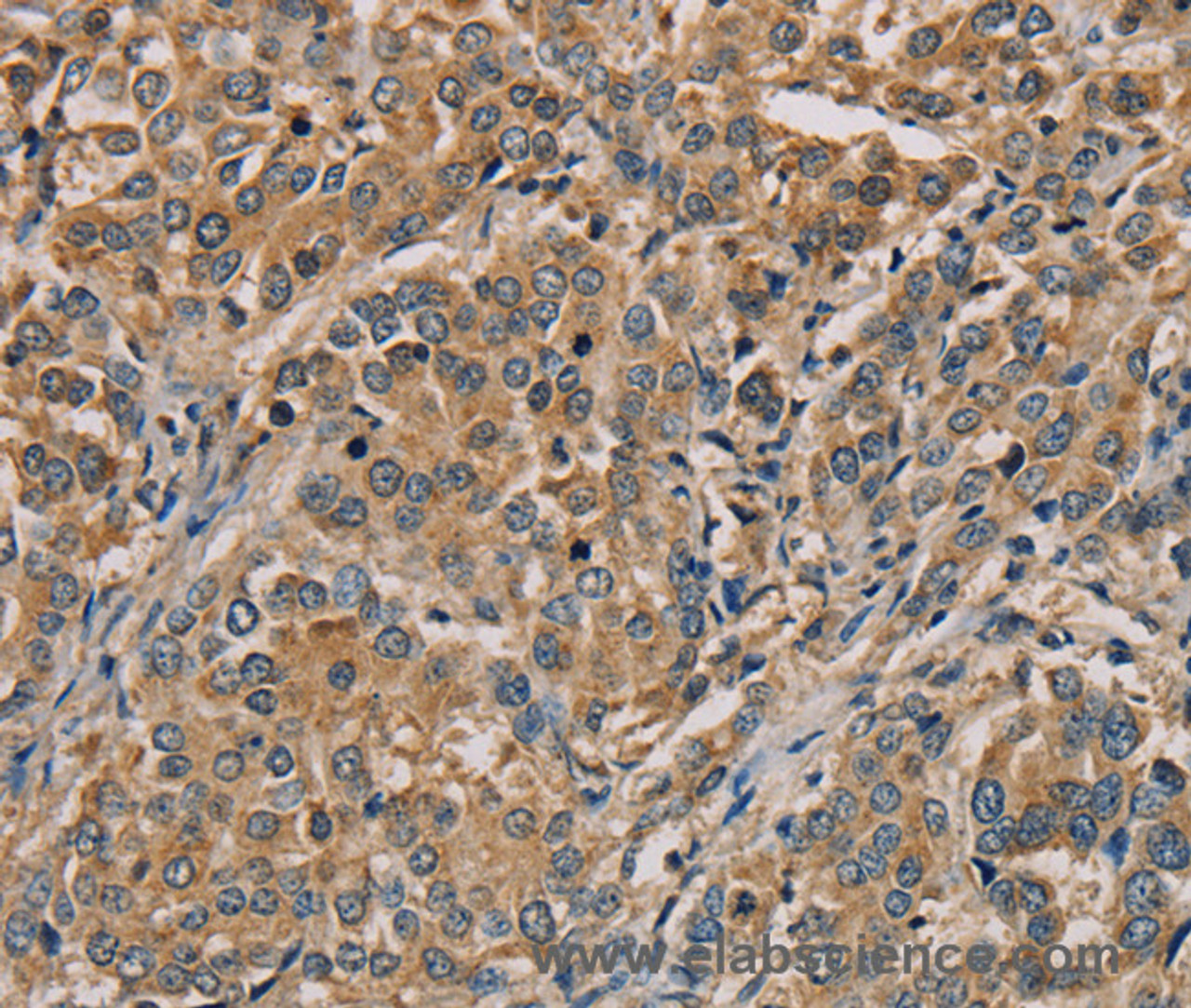 Immunohistochemistry of paraffin-embedded Human liver cancer tissue using NANOS2 Polyclonal Antibody at dilution 1:30