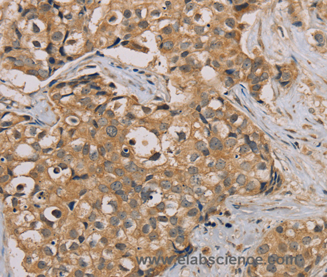 Immunohistochemistry of paraffin-embedded Human breast cancer tissue using NANOS2 Polyclonal Antibody at dilution 1:30