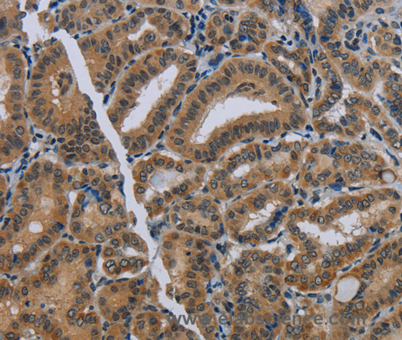 Immunohistochemistry of paraffin-embedded Human thyroid cancer using NAT10 Polyclonal Antibody at dilution of 1:40