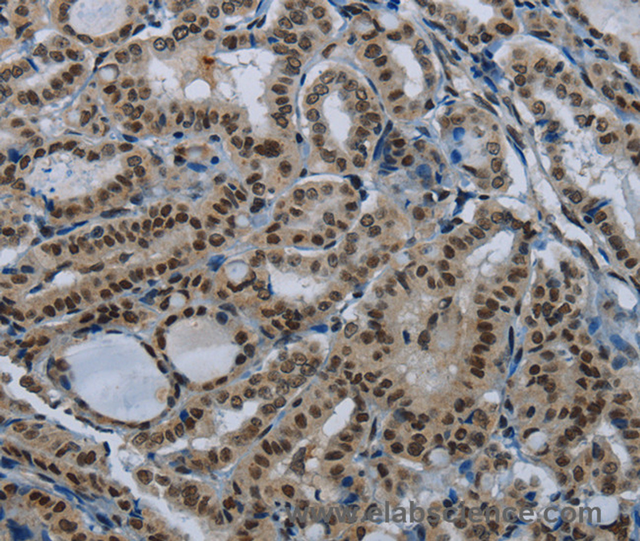 Immunohistochemistry of paraffin-embedded Human thyroid cancer tissue using DAN Polyclonal Antibody at dilution 1:50