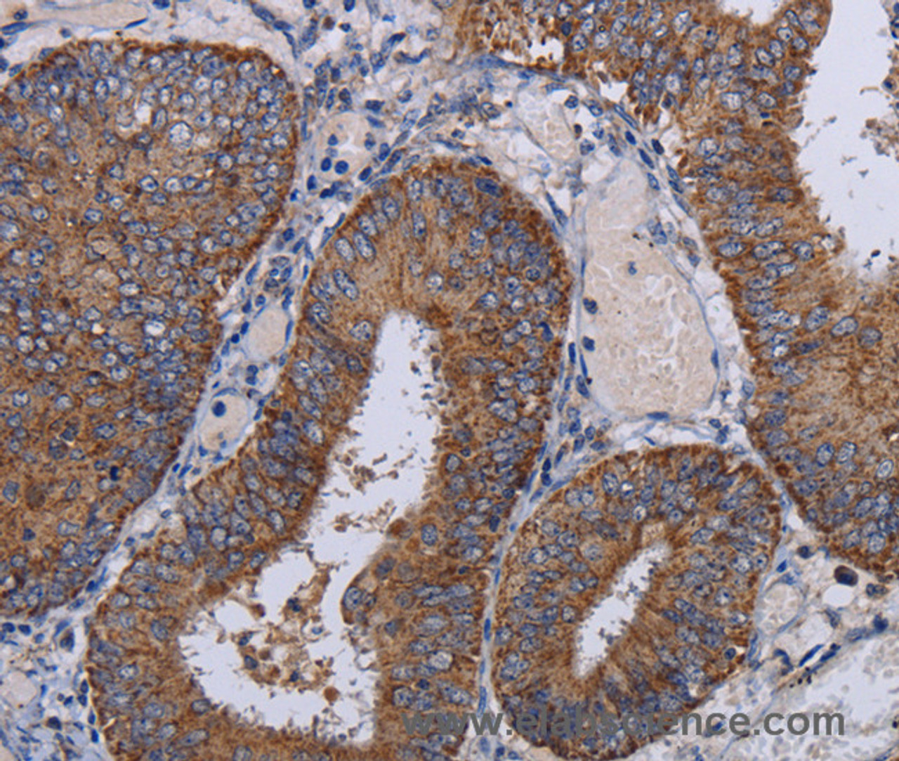Immunohistochemistry of paraffin-embedded Human colon cancer tissue using NDUFA1 Polyclonal Antibody at dilution 1:30