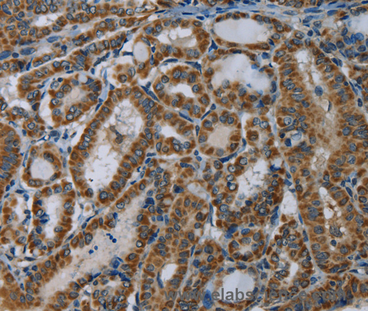 Immunohistochemistry of paraffin-embedded Human thyroid cancer using NDUFA5 Polyclonal Antibody at dilution of 1:60