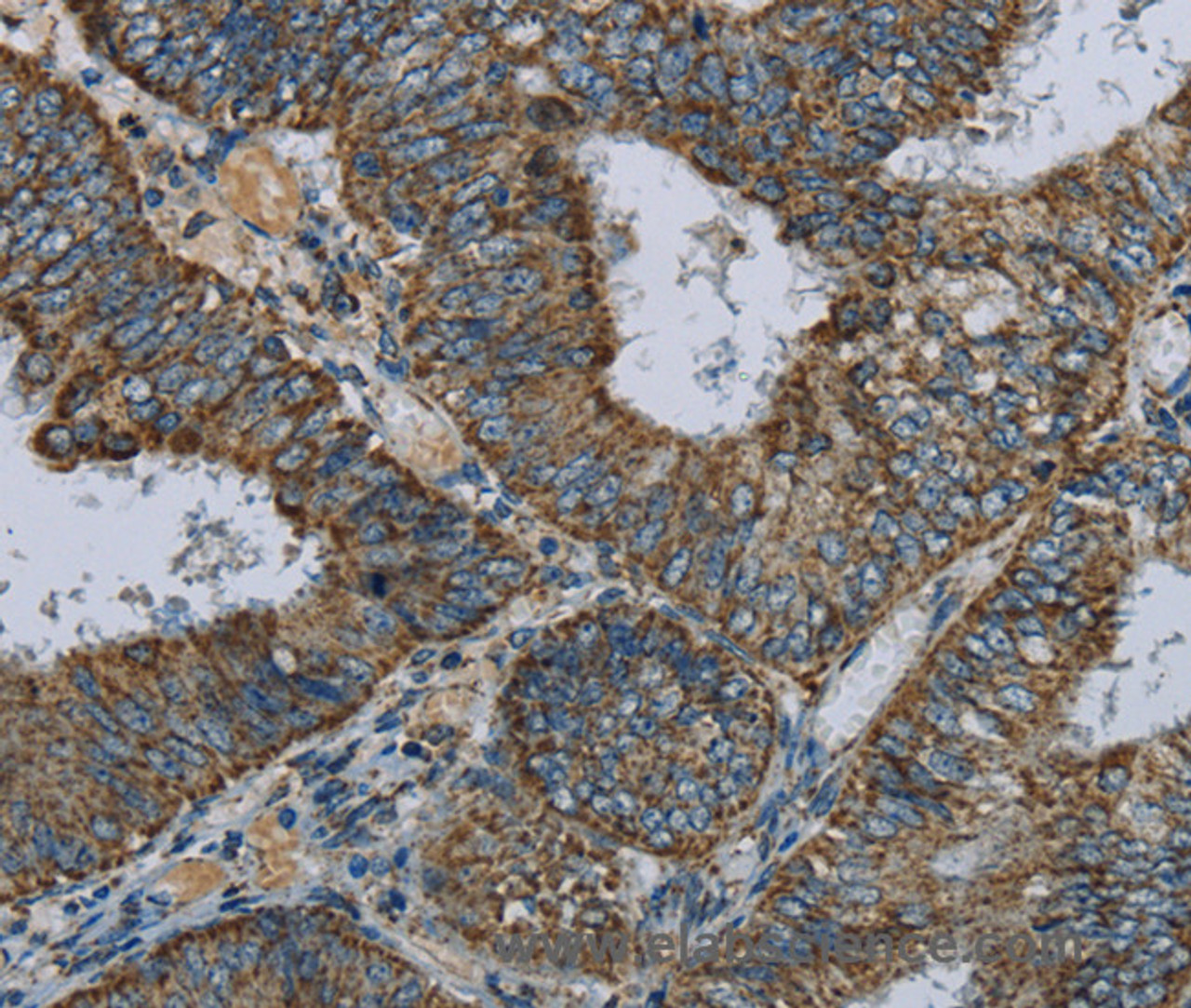 Immunohistochemistry of paraffin-embedded Human colon cancer using NDUFA5 Polyclonal Antibody at dilution of 1:60
