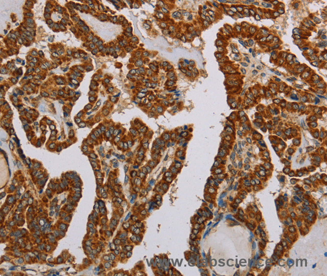 Immunohistochemistry of paraffin-embedded Human thyroid cancer using NDUFS5 Polyclonal Antibody at dilution of 1:50