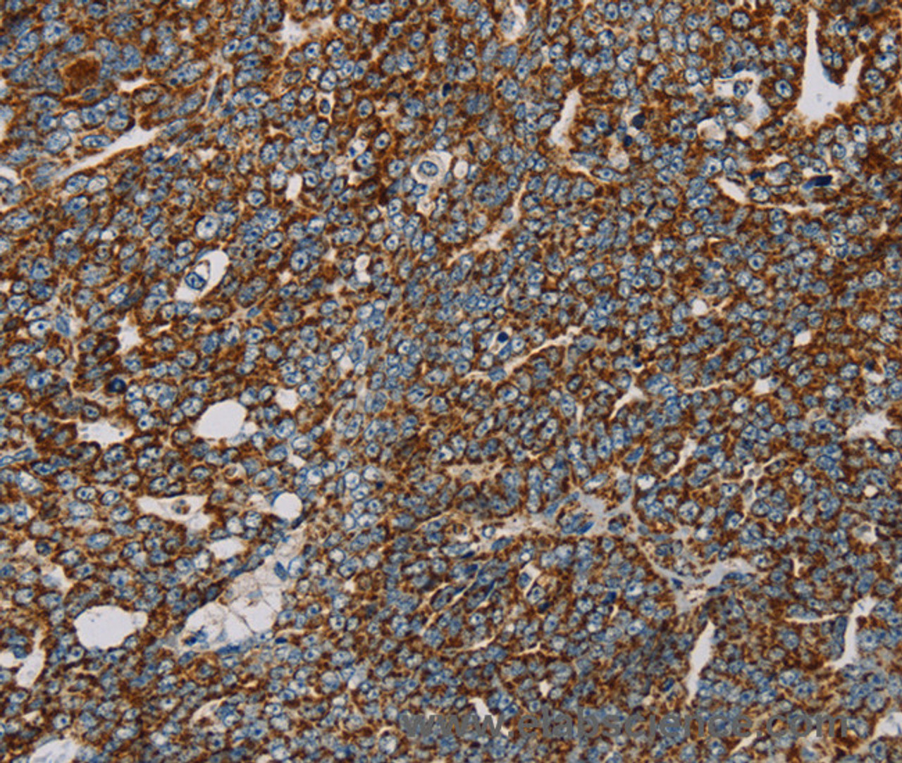 Immunohistochemistry of paraffin-embedded Human cervical cancer using NDUFS3 Polyclonal Antibody at dilution of 1:30