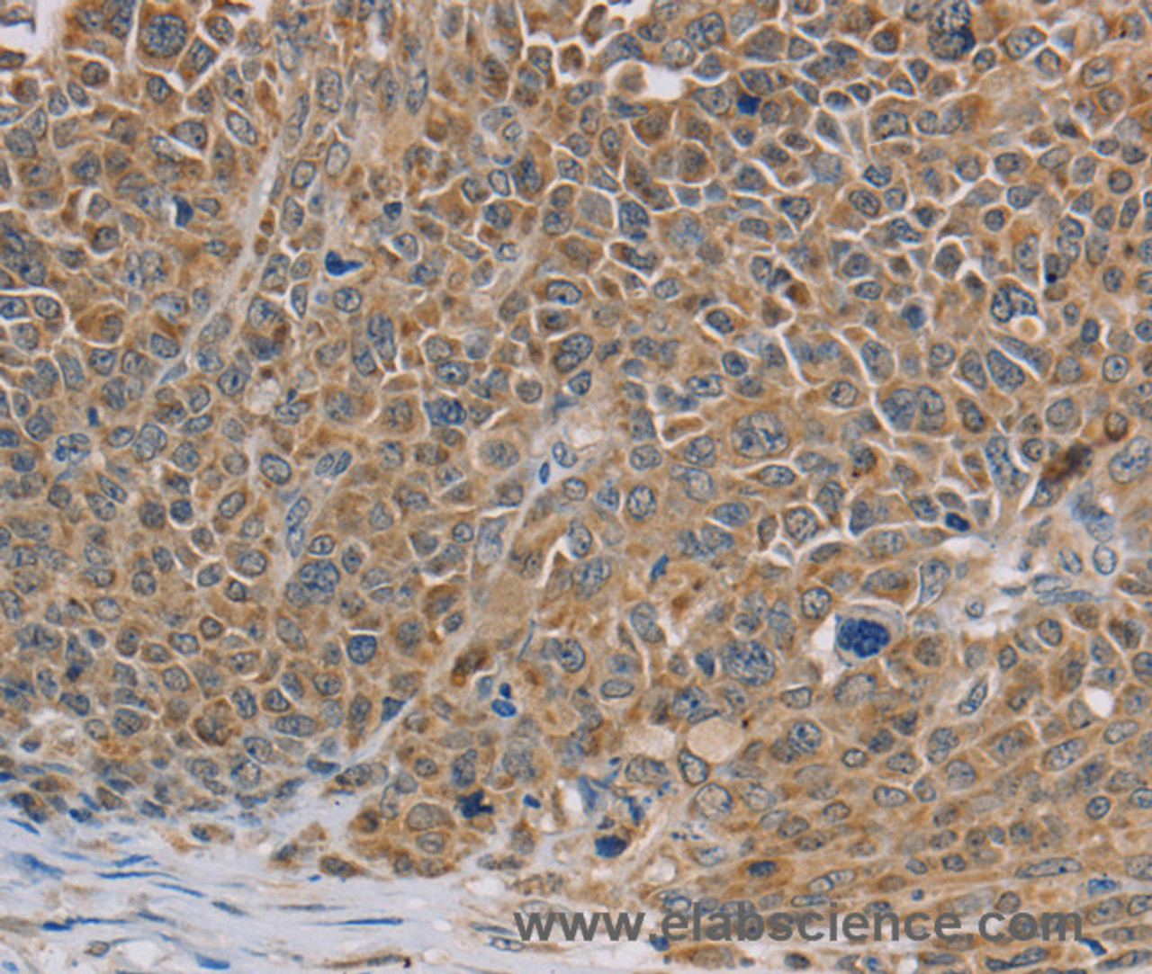 Immunohistochemistry of paraffin-embedded Human ovarian cancer tissue using NDUFS7 Polyclonal Antibody at dilution 1:40