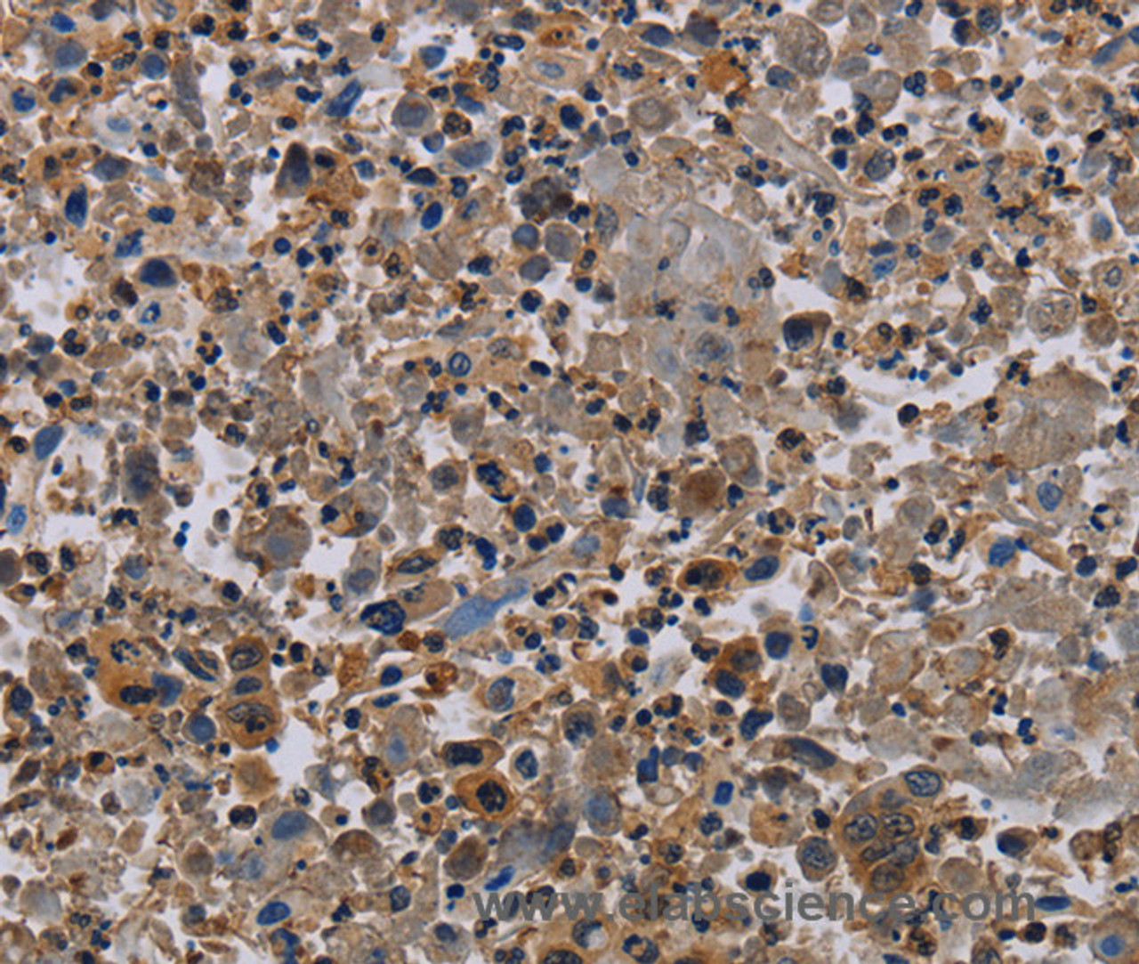 Immunohistochemistry of paraffin-embedded Human lung cancer using NECTIN4 Polyclonal Antibody at dilution of 1:60