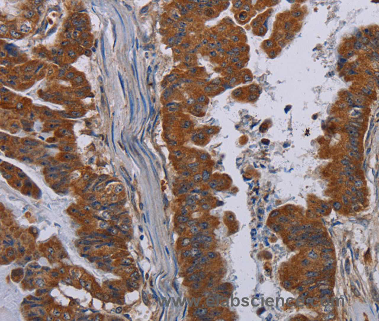 Immunohistochemistry of paraffin-embedded Human esophagus cancer tissue using NECTIN3 Polyclonal Antibody at dilution 1:40