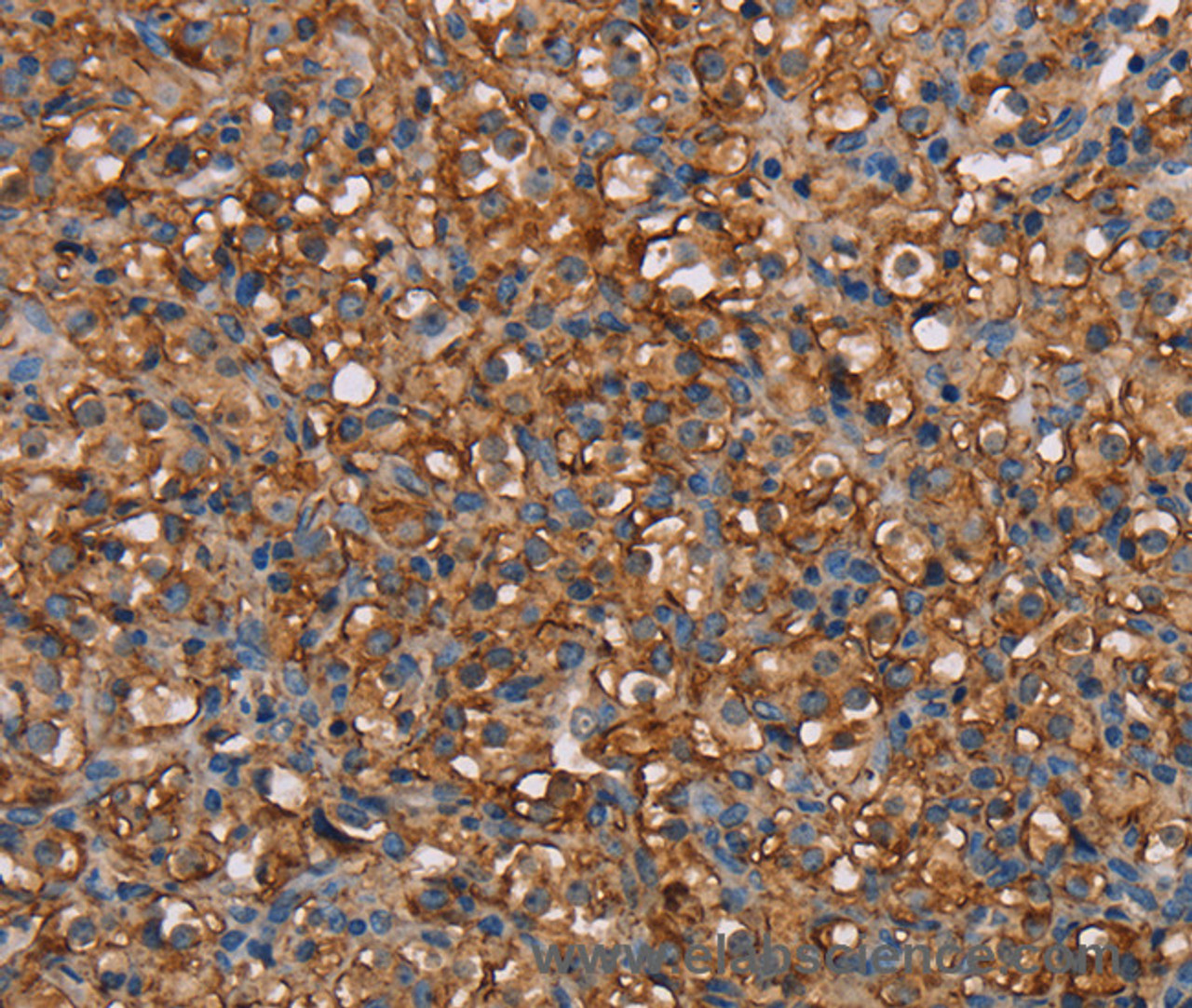 Immunohistochemistry of paraffin-embedded Human prostate cancer tissue using NEDD4L Polyclonal Antibody at dilution 1:60