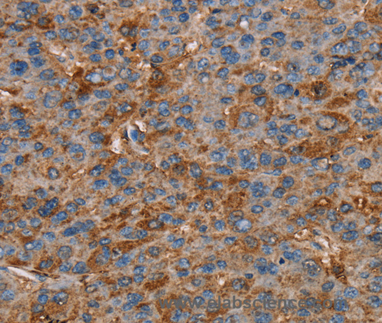 Immunohistochemistry of paraffin-embedded Human liver cancer tissue using NEDD4L Polyclonal Antibody at dilution 1:60
