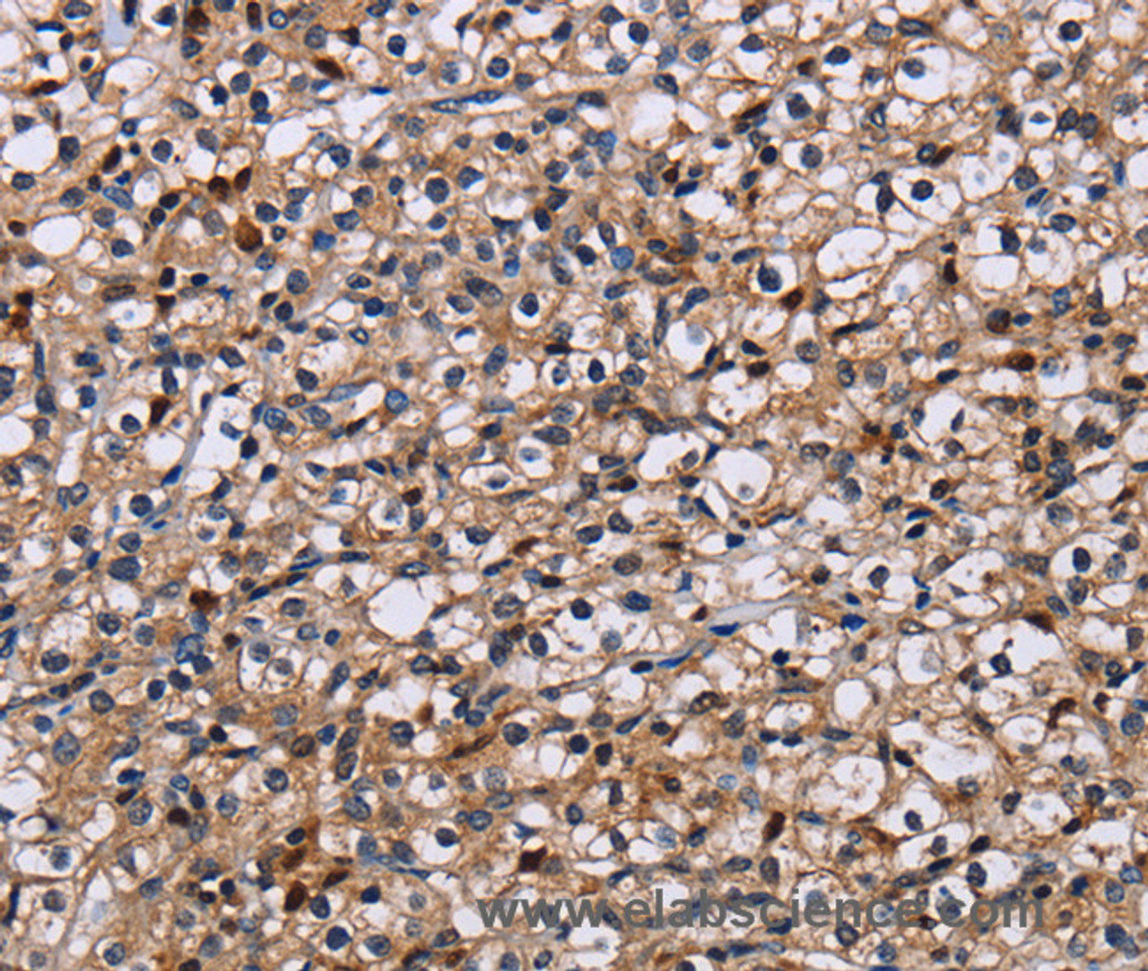 Immunohistochemistry of paraffin-embedded Human prostate cancer using NCSTN Polyclonal Antibody at dilution of 1:50