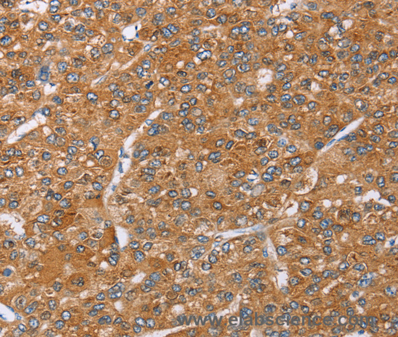 Immunohistochemistry of paraffin-embedded Human liver cancer using PAICS Polyclonal Antibody at dilution of 1:35