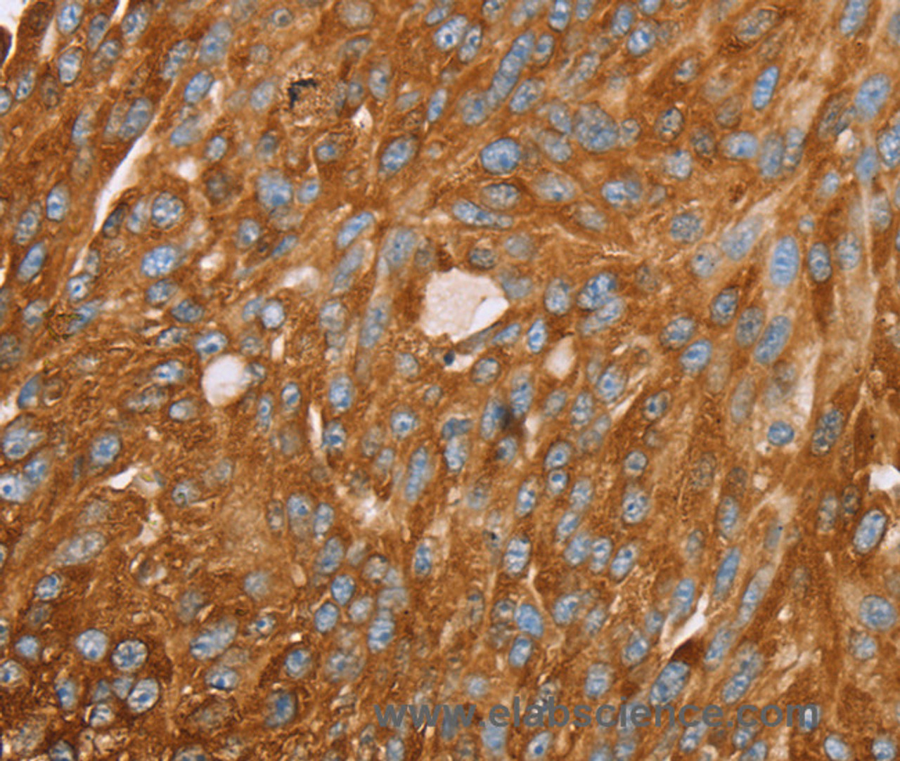 Immunohistochemistry of paraffin-embedded Human breast cancer using PAICS Polyclonal Antibody at dilution of 1:35