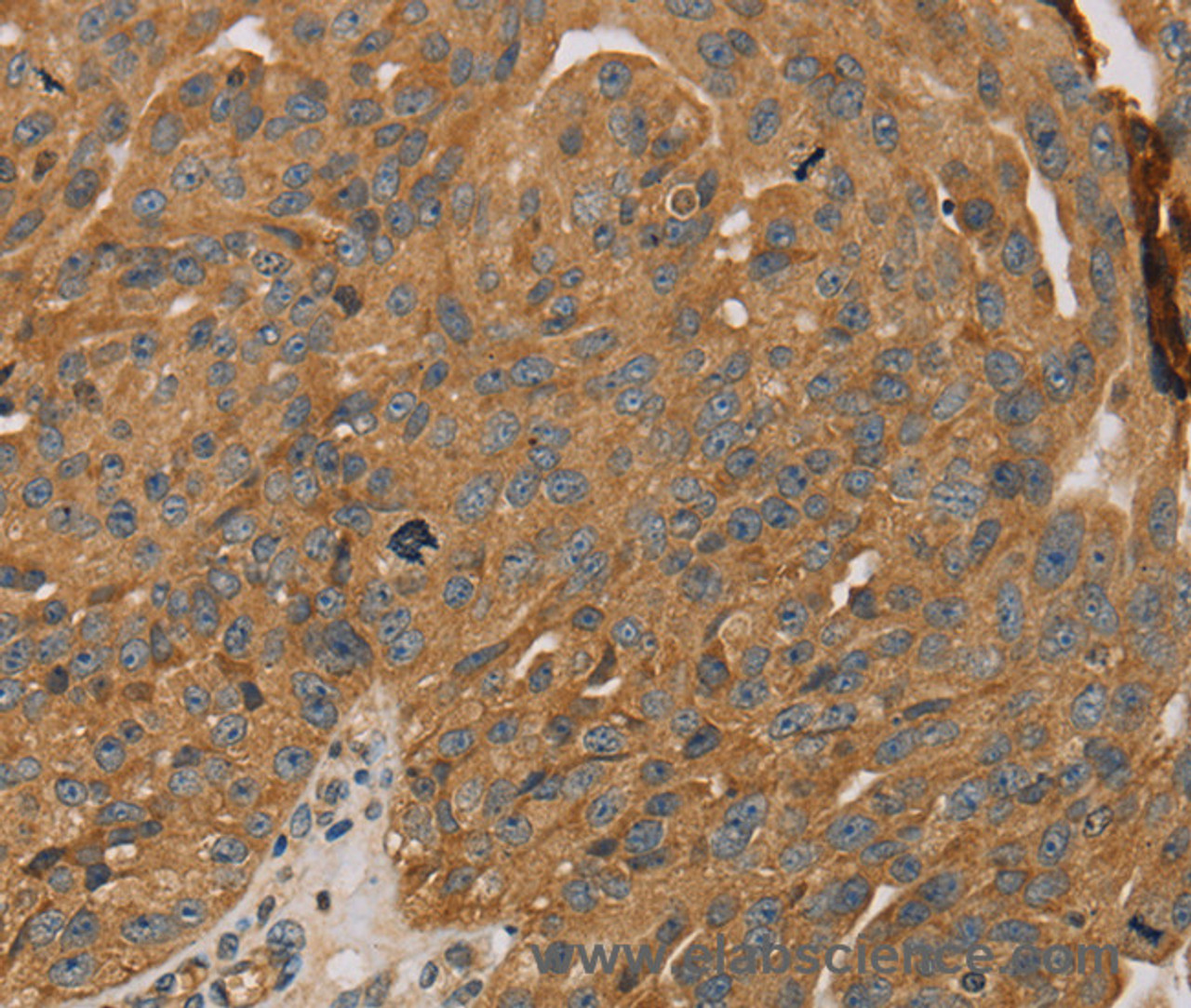 Immunohistochemistry of paraffin-embedded Human breast cancer tissue using PARP11 Polyclonal Antibody at dilution 1:30
