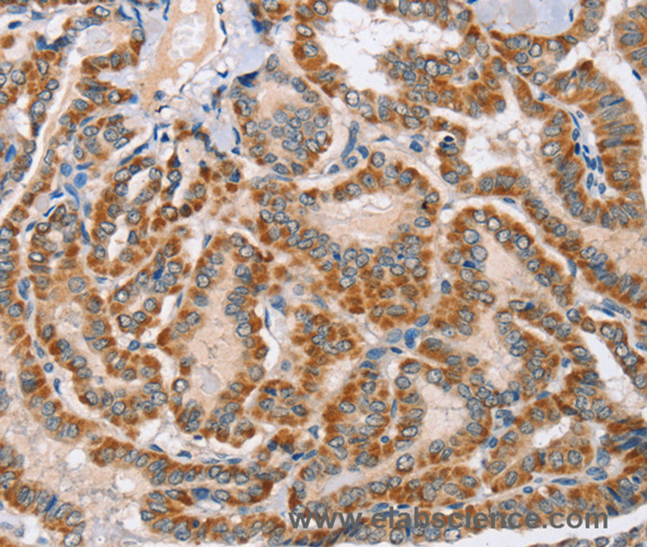 Immunohistochemistry of paraffin-embedded Human thyroid cancer using MSMB Polyclonal Antibody at dilution of 1:30