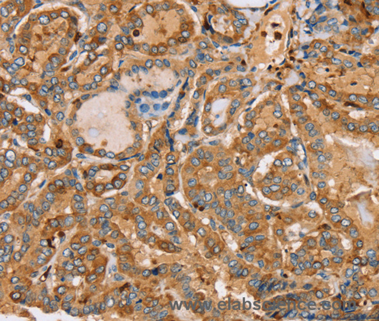Immunohistochemistry of paraffin-embedded Human thyroid cancer using PLS3 Polyclonal Antibody at dilution of 1:30