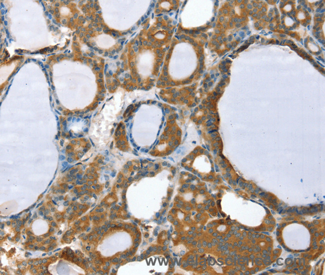 Immunohistochemistry of paraffin-embedded Human thyroid cancer using PPP2CA Polyclonal Antibody at dilution of 1:35