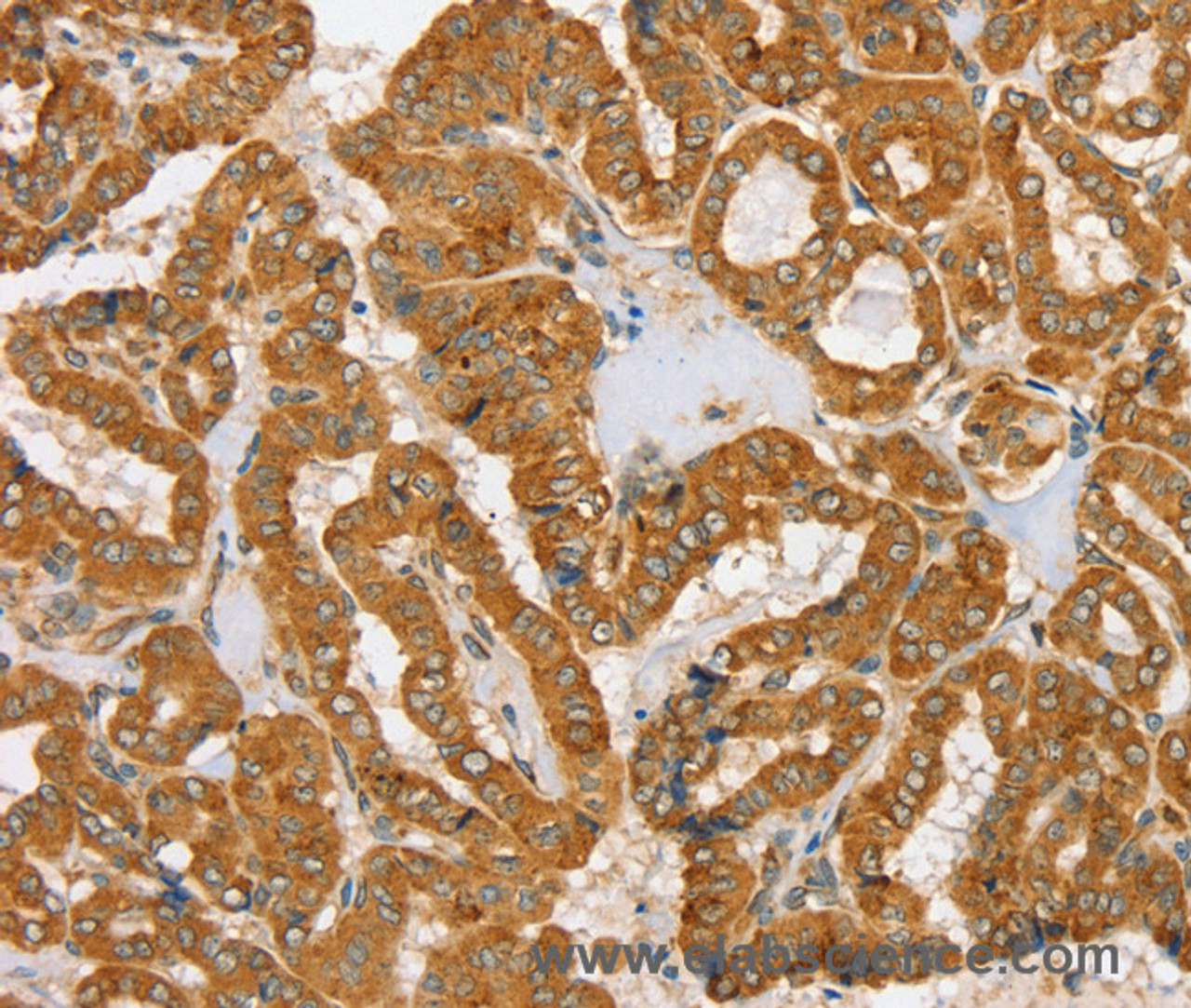 Immunohistochemistry of paraffin-embedded Human thyroid cancer tissue using PDP1 Polyclonal Antibody at dilution 1:30