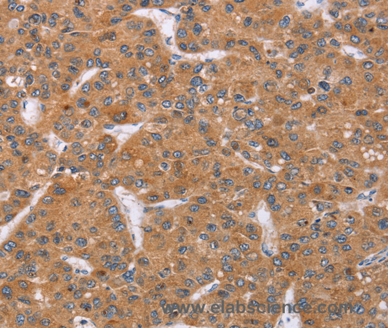 Immunohistochemistry of paraffin-embedded Human liver cancer tissue using PPP2R3C Polyclonal Antibody at dilution 1:30