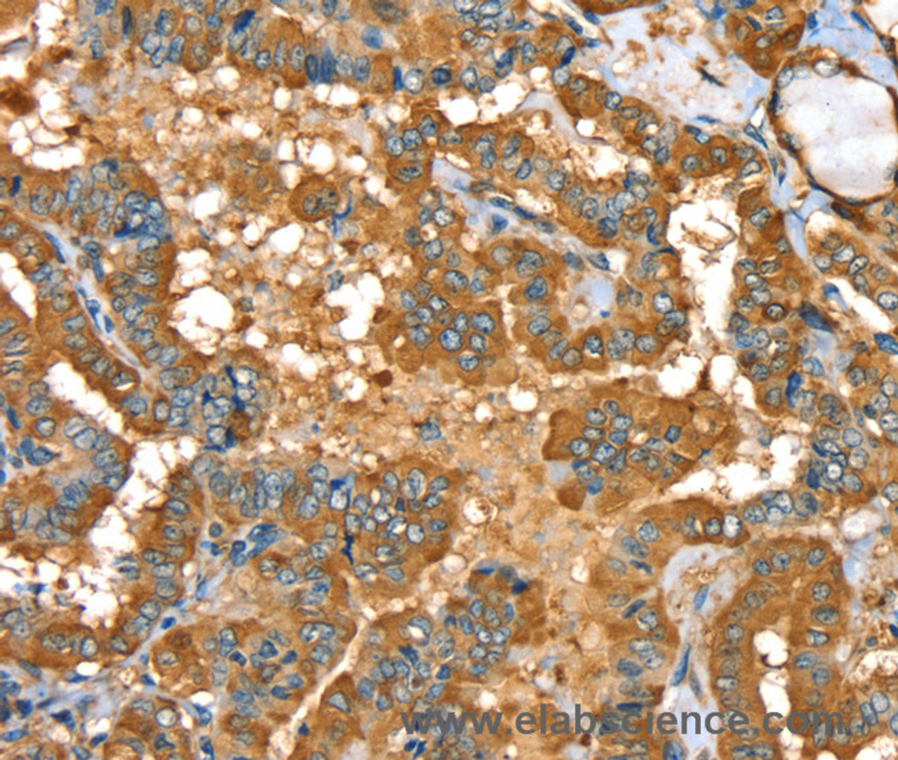 Immunohistochemistry of paraffin-embedded Human thyroid cancer using PYGL Polyclonal Antibody at dilution of 1:35