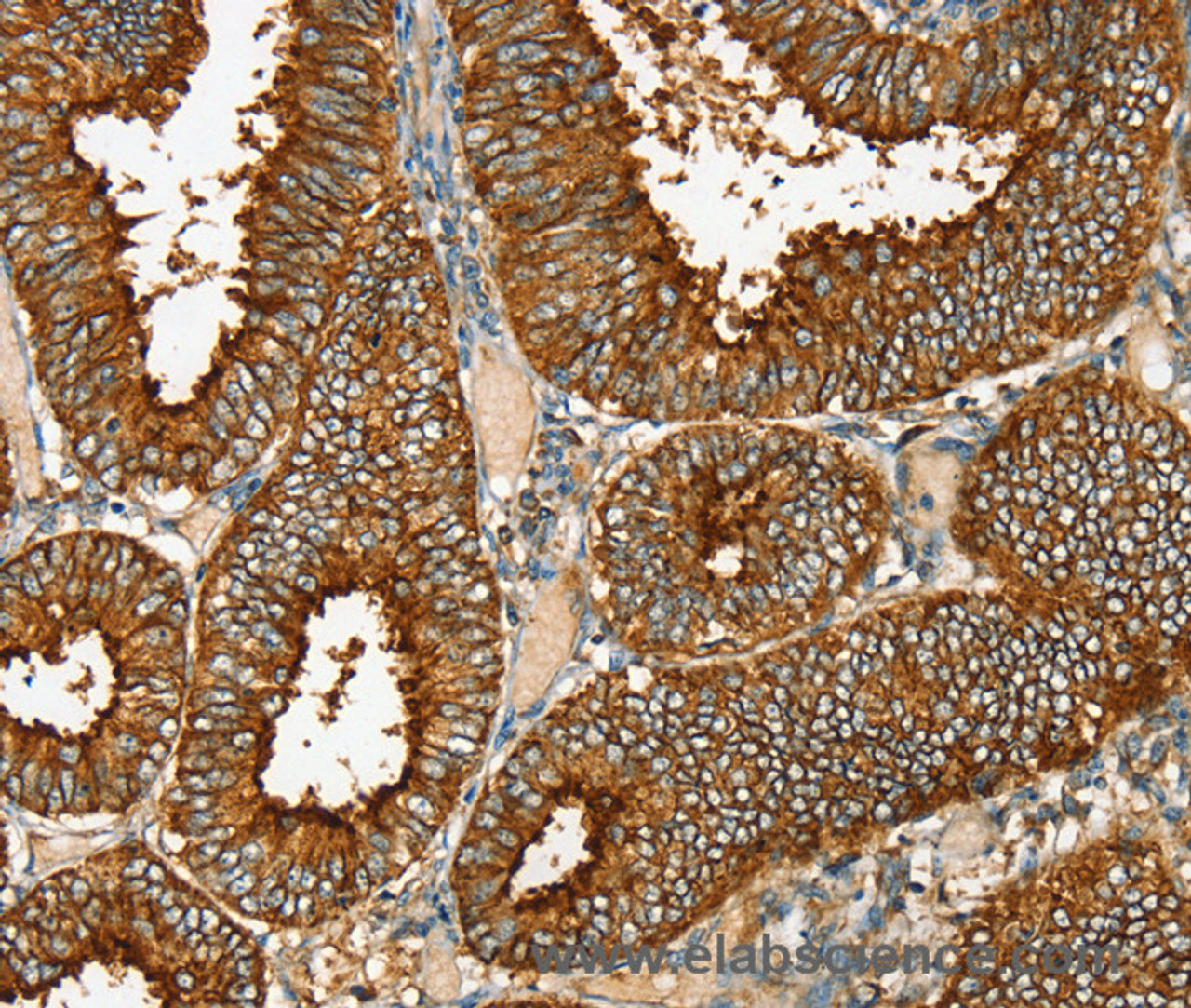 Immunohistochemistry of paraffin-embedded Human cervical cancer tissue using RAB25 Polyclonal Antibody at dilution 1:35