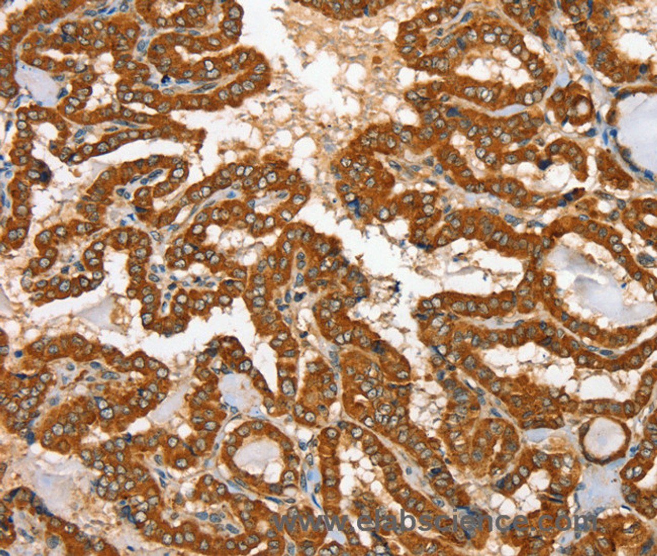 Immunohistochemistry of paraffin-embedded Human thyroid cancer tissue using RAB25 Polyclonal Antibody at dilution 1:35