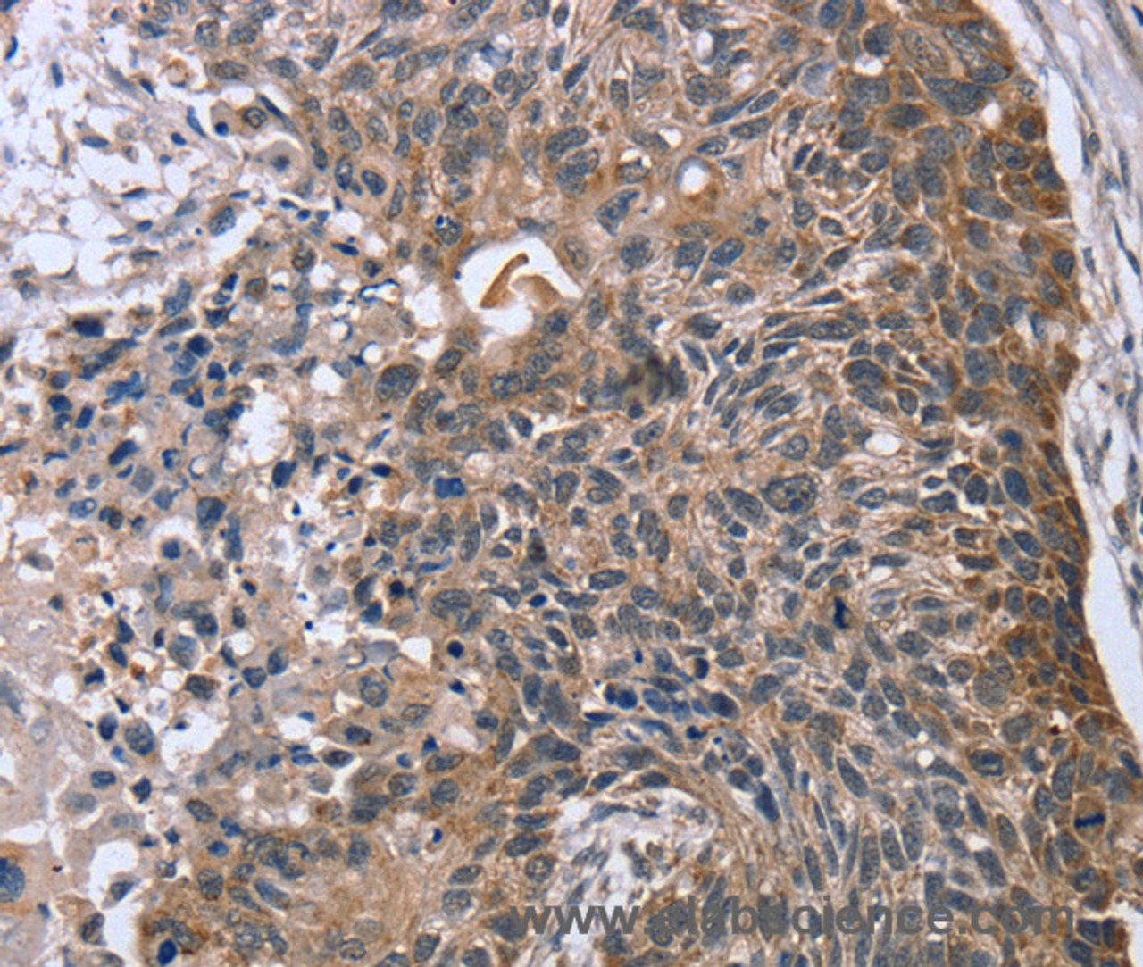 Immunohistochemistry of paraffin-embedded Human esophagus cancer using RASSF7 Polyclonal Antibody at dilution of 1:45