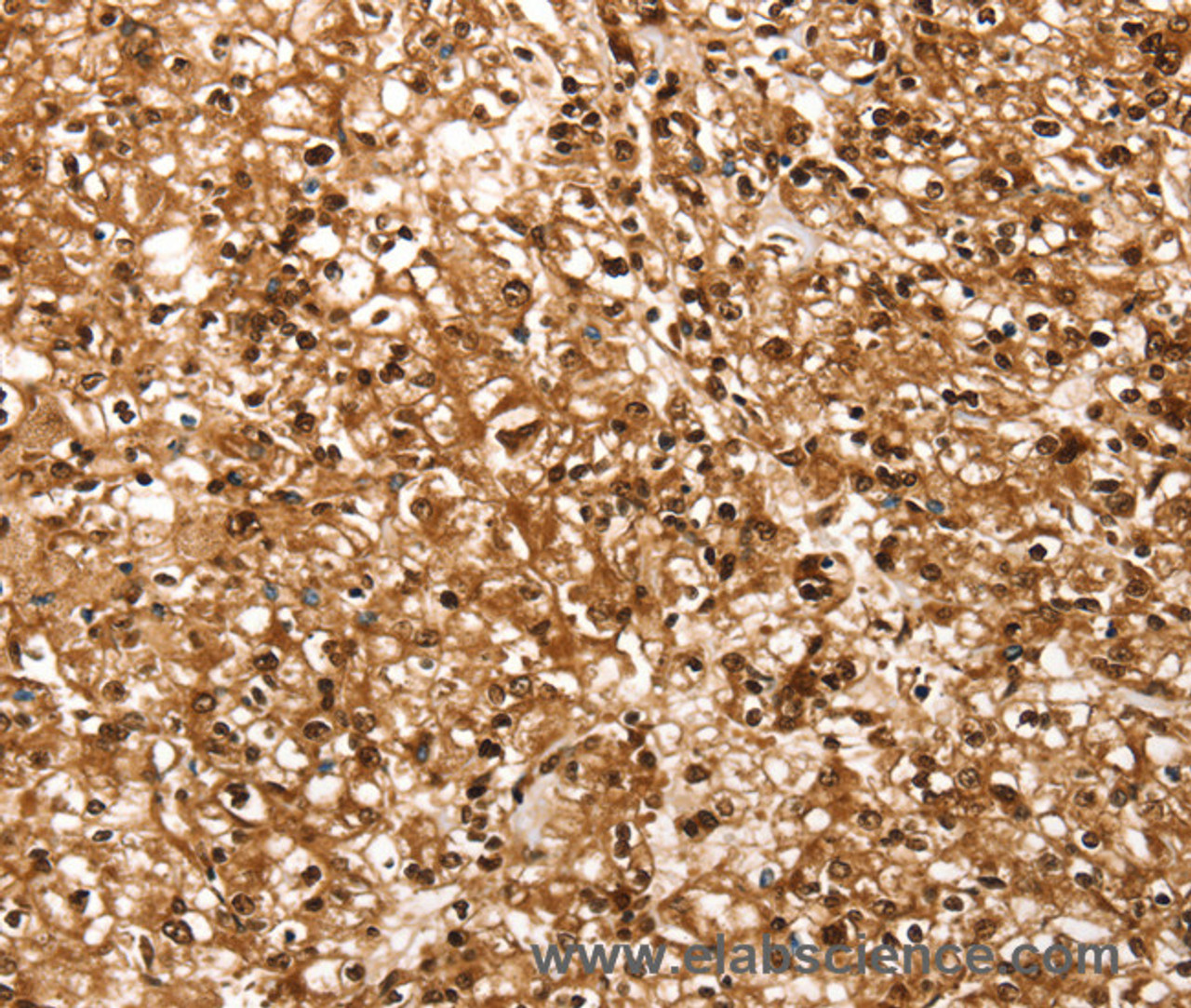 Immunohistochemistry of paraffin-embedded Human prostate cancer using RBM5 Polyclonal Antibody at dilution of 1:30