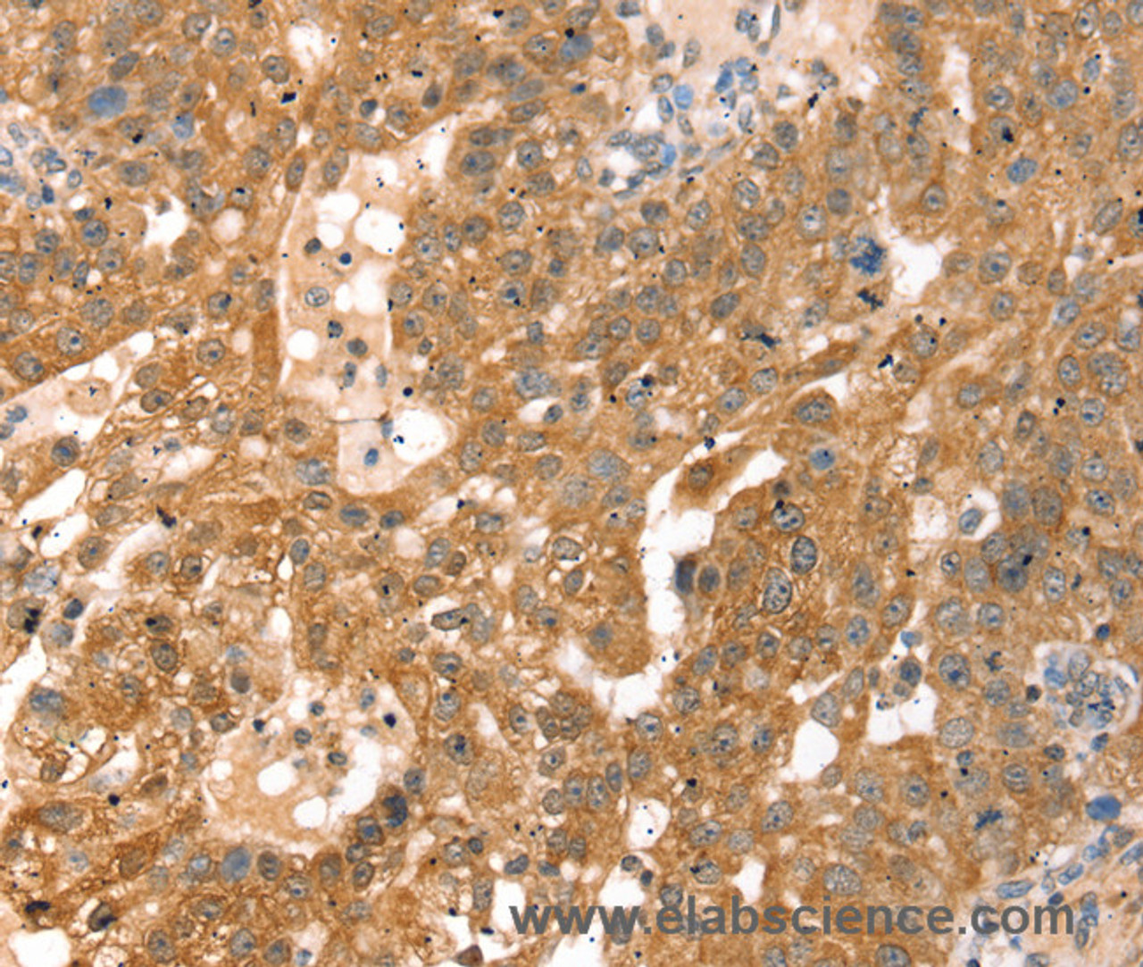 Immunohistochemistry of paraffin-embedded Human breast cancer using RPS6KA1 Polyclonal Antibody at dilution of 1:30
