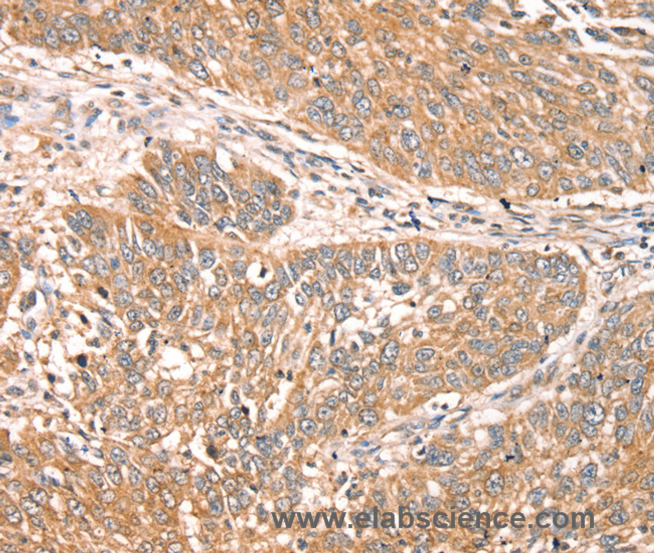 Immunohistochemistry of paraffin-embedded Human lung cancer using RPS6KA1 Polyclonal Antibody at dilution of 1:30