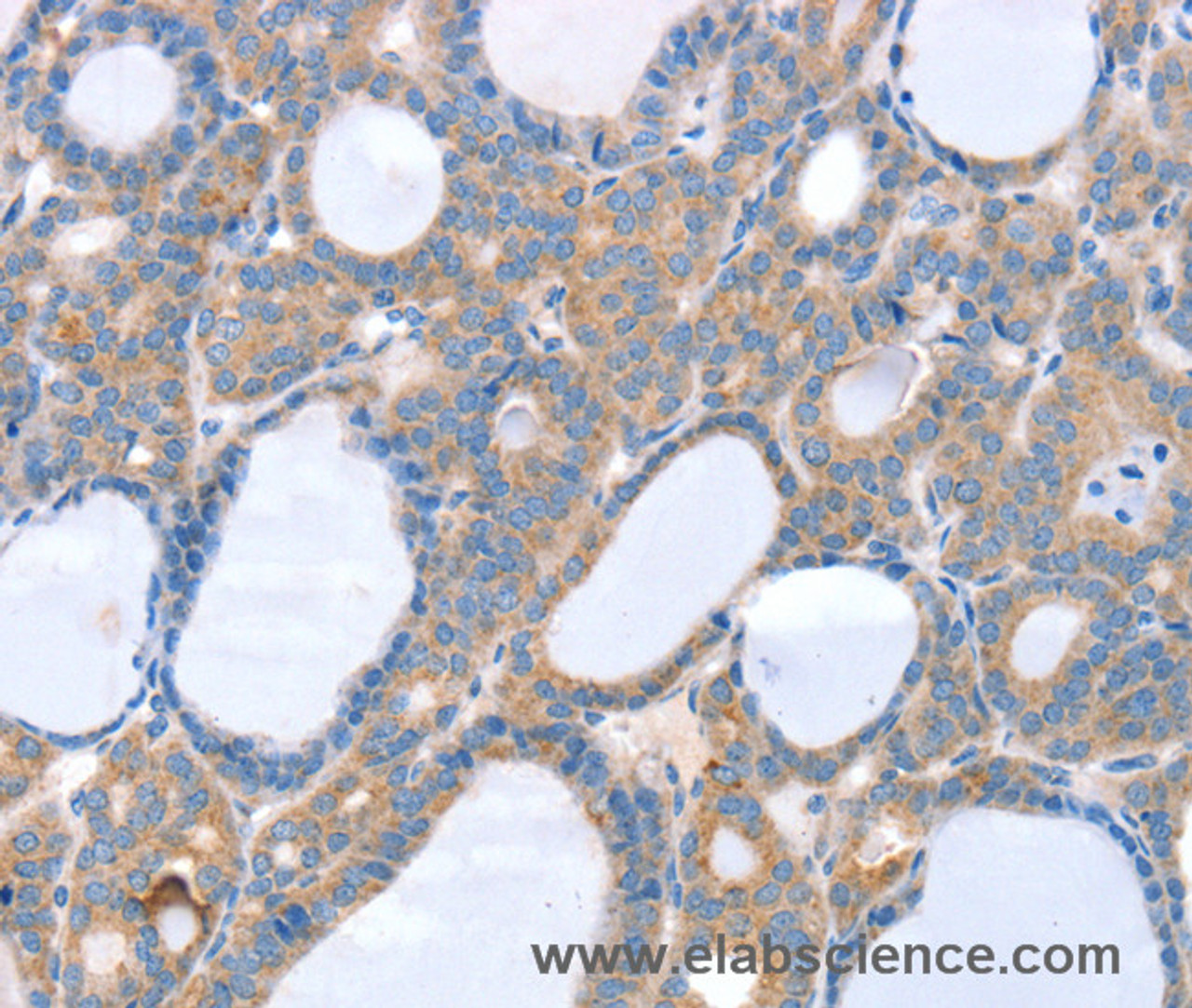 Immunohistochemistry of paraffin-embedded Human thyroid cancer using SLC25A13 Polyclonal Antibody at dilution of 1:35