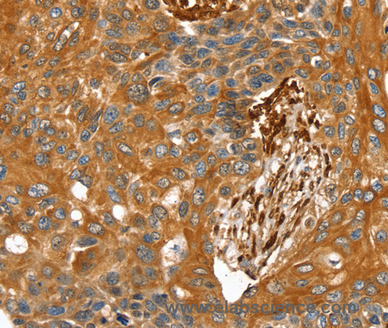 Immunohistochemistry of paraffin-embedded Human esophagus cancer tissue using TAGLN Polyclonal Antibody at dilution 1:30