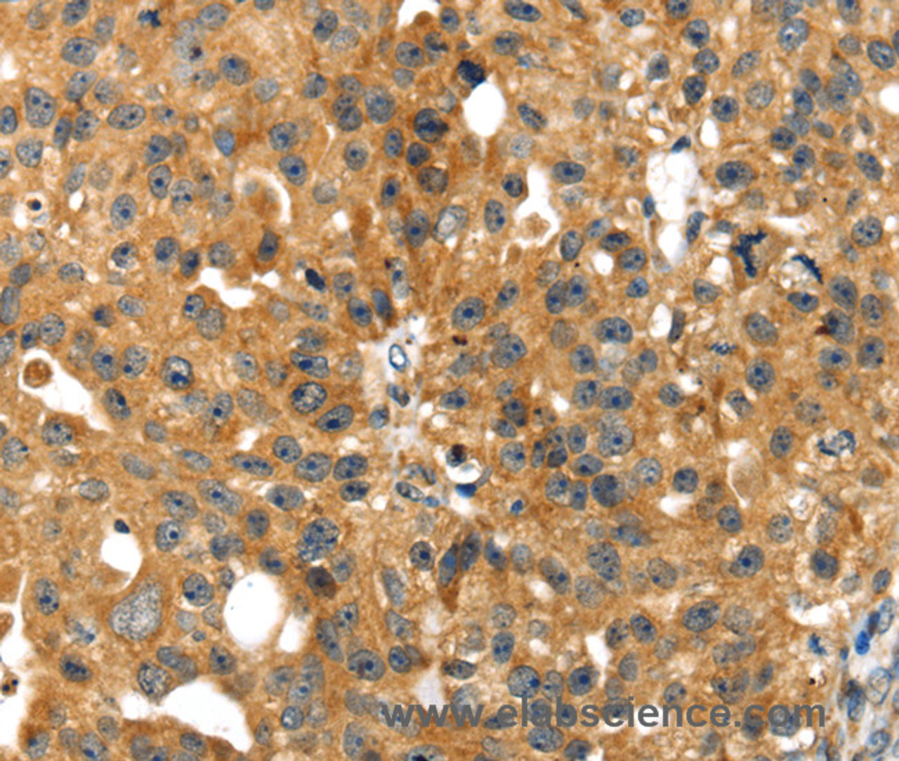 Immunohistochemistry of paraffin-embedded Human breast cancer tissue using SMYD4 Polyclonal Antibody at dilution 1:40