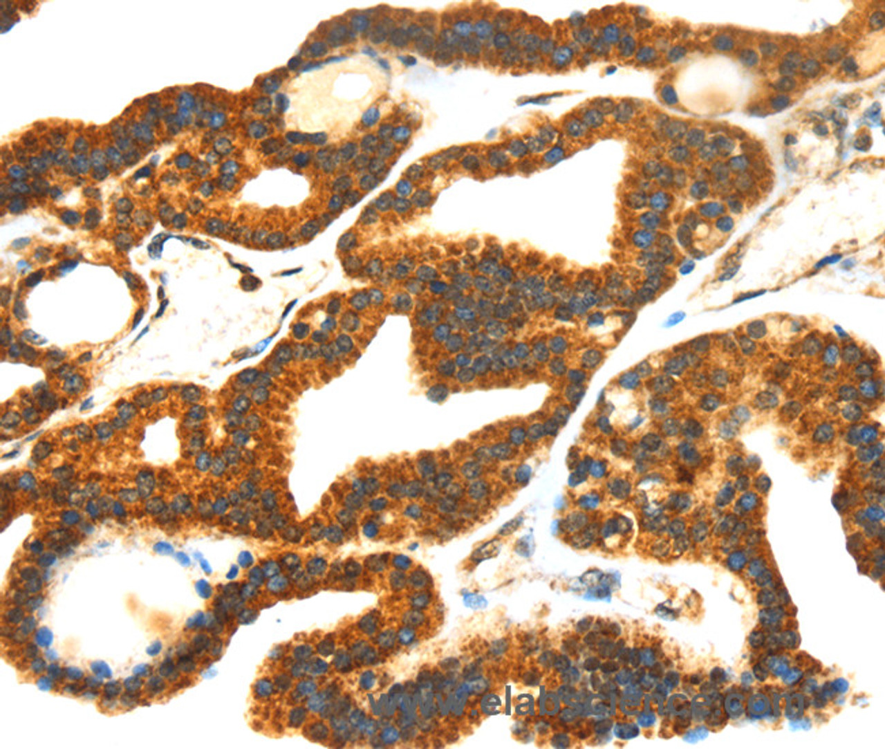 Immunohistochemistry of paraffin-embedded Human thyroid cancer tissue using SMYD4 Polyclonal Antibody at dilution 1:40