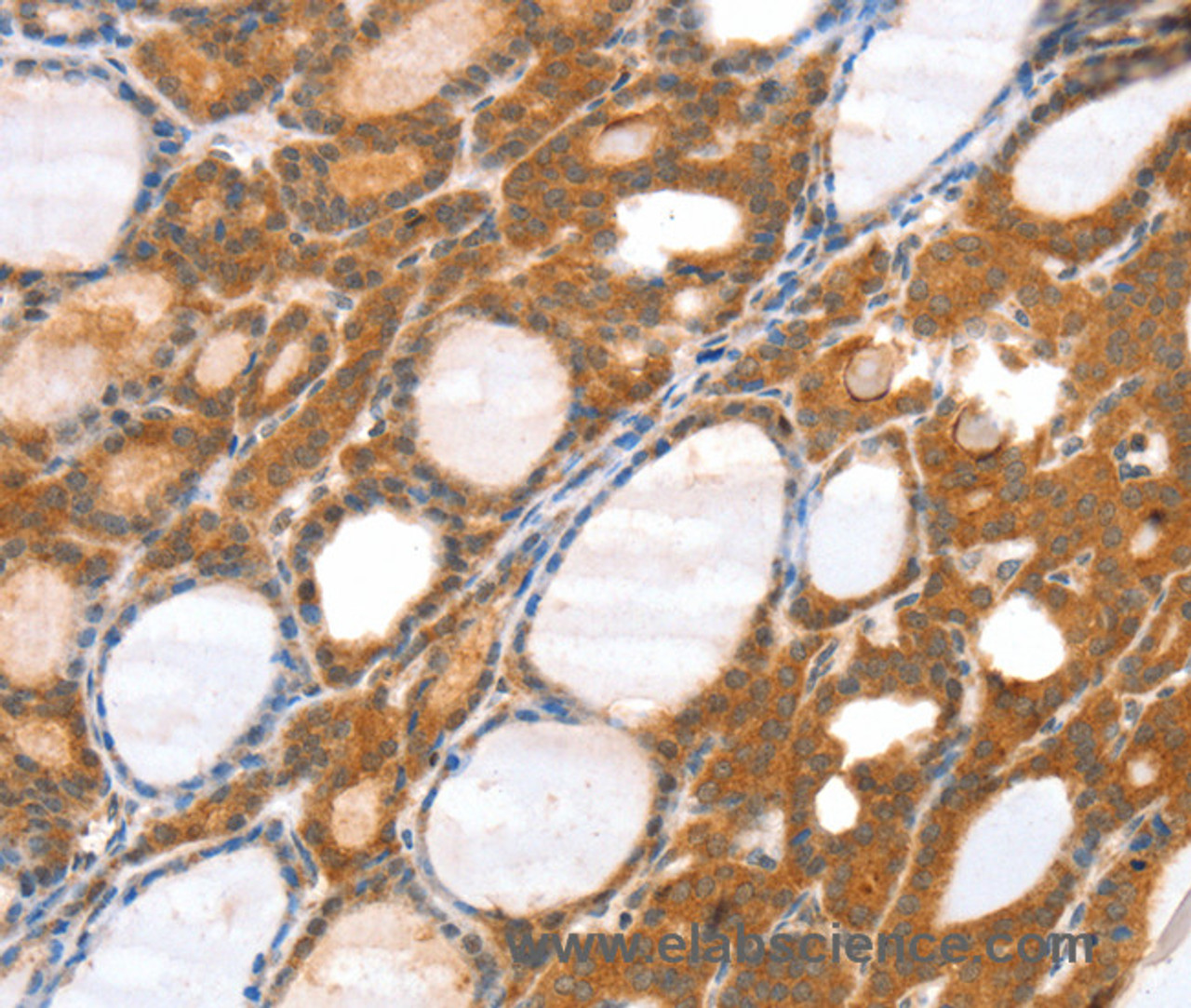 Immunohistochemistry of paraffin-embedded Human thyroid cancer tissue using SRGAP3 Polyclonal Antibody at dilution 1:40